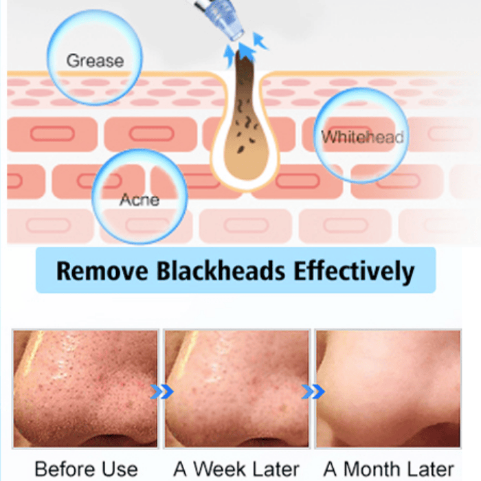 Derma Suction Blackhead Remover – Deep Clean & Skin Smoother